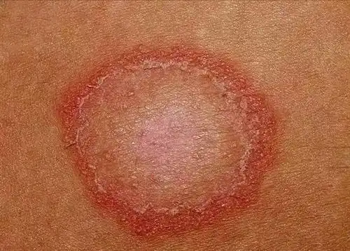 治疗股癣最好的药如何预防股癣复发