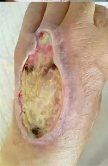 一例输液外渗致皮肤坏死的救治体会(满满干货,医护必读)