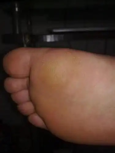 你好你的前脚掌肿痛治好了吗?