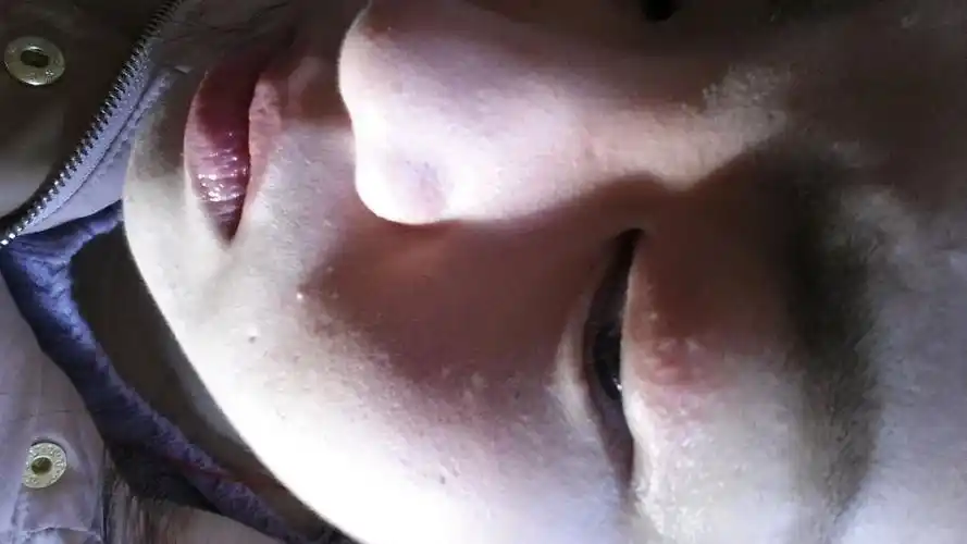 眼睛眼皮上起像小包的颗粒