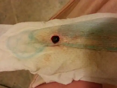 着床出血的症状和感觉