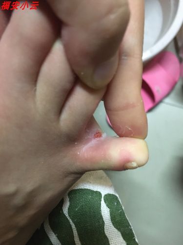 脚底板泛白脚气红 痒 草根大夫苗药皮藓癣王药膏草根大夫