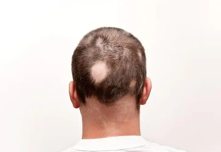 这种药对脱发有效短期别停至少用1年可能还有副作用