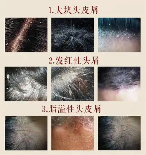 头癣头部牛皮肤癣脂溢性皮炎头皮藓银屑癣止痒膏煤焦油洗发水液硫磺