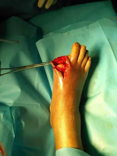 三亚市中医院骨四科创面修复报告