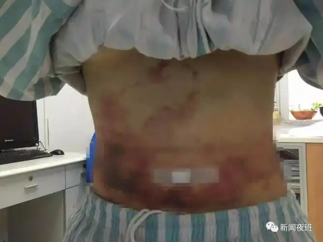 可怕!南宁一女孩做吸脂手术,腰部竟出现大片淤黑!医生:再不治疗就会.