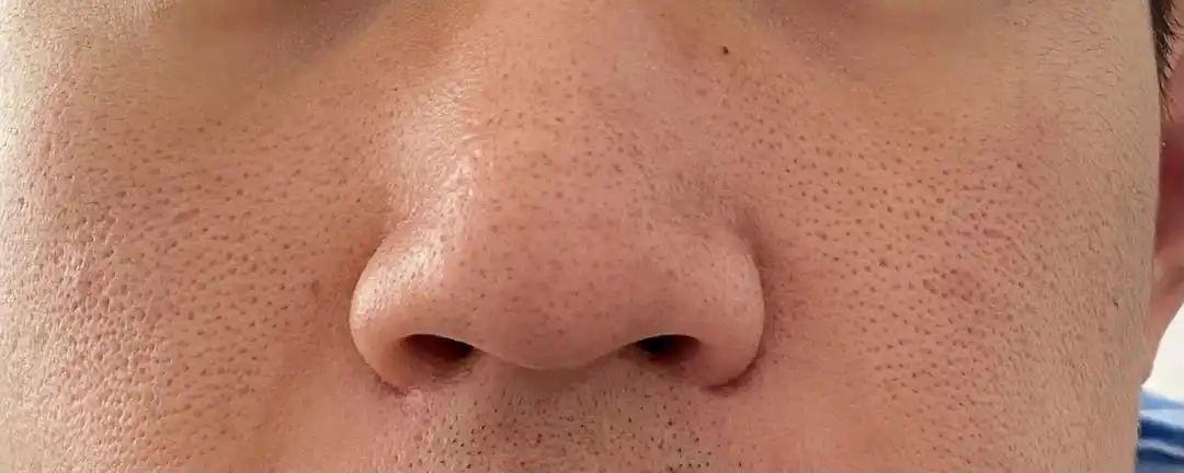 我的皮肤怎么拯救呢