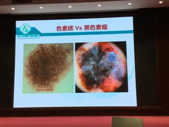 黑素细胞皮肤肿瘤皮肤镜鉴别特点及要点 辛琳琳教授