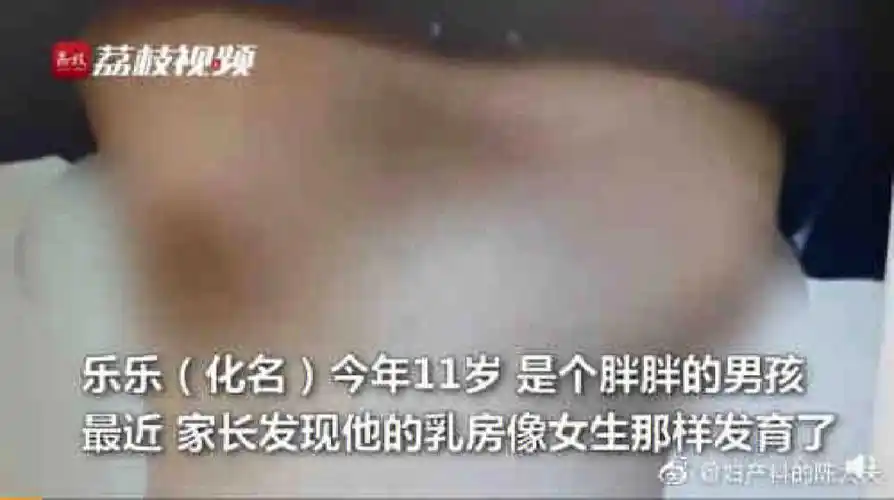 不要让男孩吃太胖否则会像他一样乳腺发育