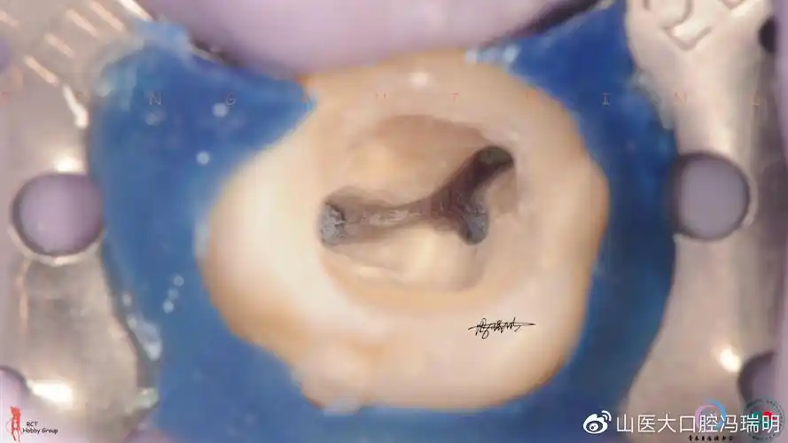 上颌第二磨牙根管解剖形态特点及病例分享