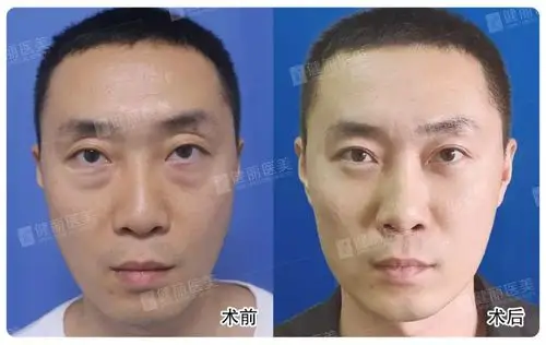 谁说男人不用去眼袋