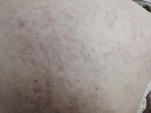 皮肤,后背皮肤长了很多东西