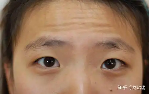 什么是上睑下垂? - 知乎