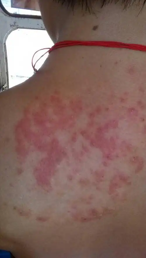 有一段时间了,买了药膏擦,好了又长了,也不痛热的时候会有点痒,这是