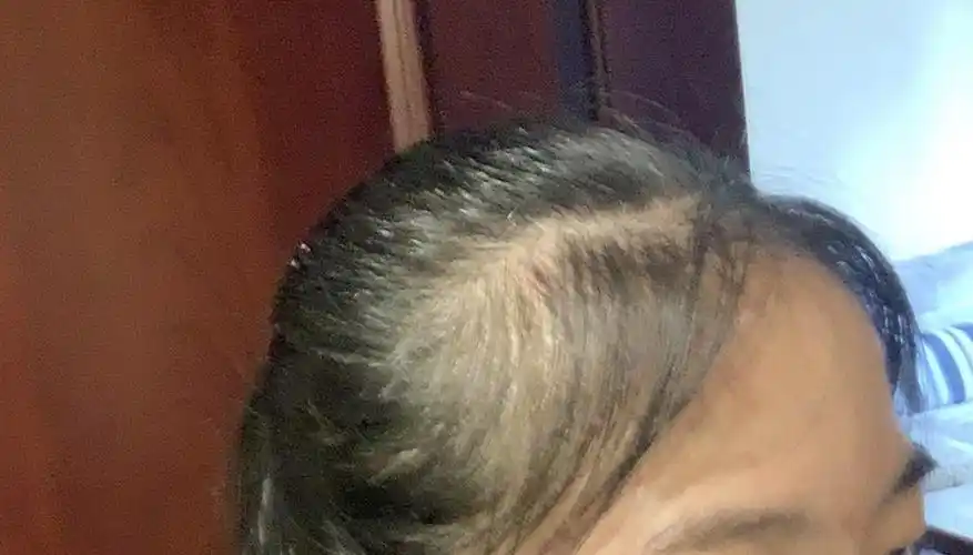 两鬓秃成这样了应该怎么拯救(慎