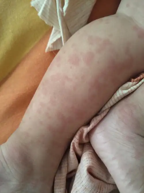 1岁孩子荨麻疹反复发作