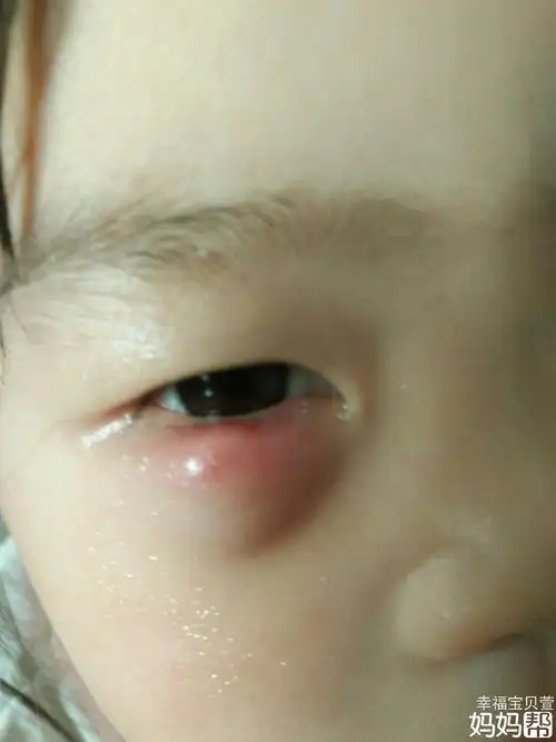 长了麦粒肿如何治疗方法(长了麦粒肿如何治疗方法视频)