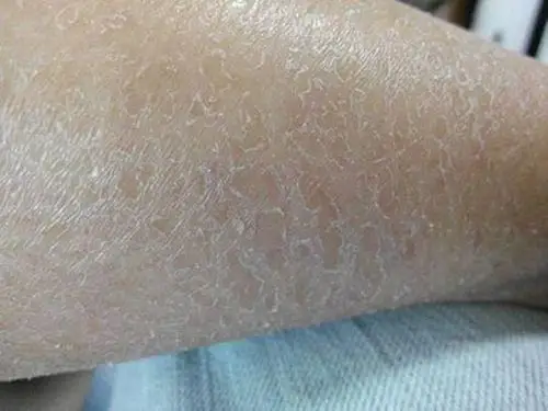 冬天里洗浴不要用太热的水,防止过度洗去皮脂,使得皮肤更干燥,容易起