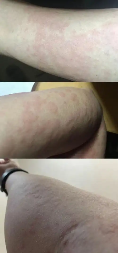 祖传荨麻疹止痒秘方——挠挠?