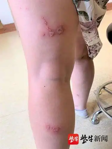 皮肤瘙痒一挠竟导致溃烂,原是虫子惹的祸