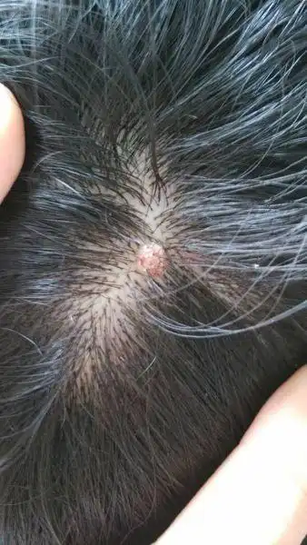 头皮上长个这个是什么东西,一开始以为是豆豆,用手扣完变大了,肉疙瘩
