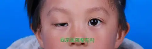 先天性上睑下垂是临床常见的眼部畸形,不仅妨碍美观,还可造成剥夺性