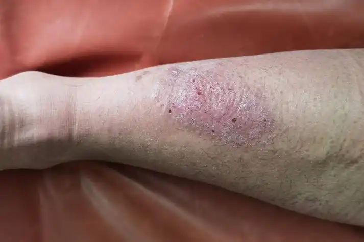 成人湿疹症状图片 - 成人湿疹症状图片 - 实验室设备网