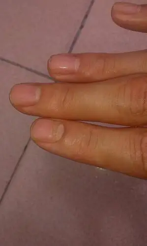 这个食指的指甲怎么了,指甲根部的肉都没了,看起来很恐怖,这是什么病.