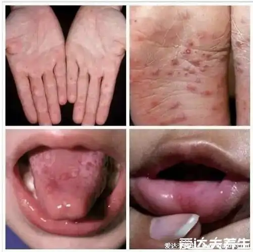 人体100种皮肤病对照图症状及名称,皮肤病种类及对应图片大片