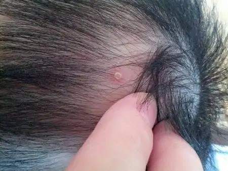 问:三个多月宝贝,脑袋后面长了好多小疙瘩,像火疖子,请问哪位知道这是