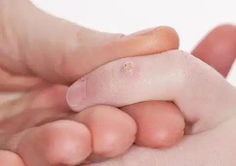 疣的种类寻常疣图片