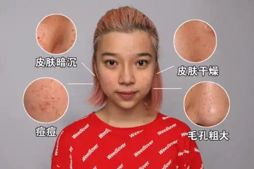 其实肤色的暗沉只是一个形容词,一个各种面部皮肤问题集合现象的总称.