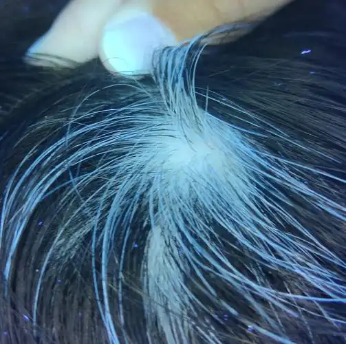 头皮上孤零零出现一绺白发,可能是什么原因?_白癜风 - 好大夫在线