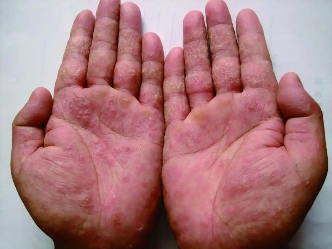 癣菌疹图片 癣菌疹症状图 癣菌疹病例图 皮肤性病科图谱真菌性皮肤病