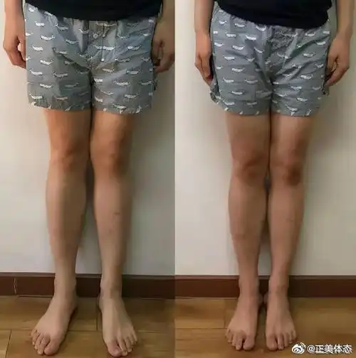 怎样判断内八字