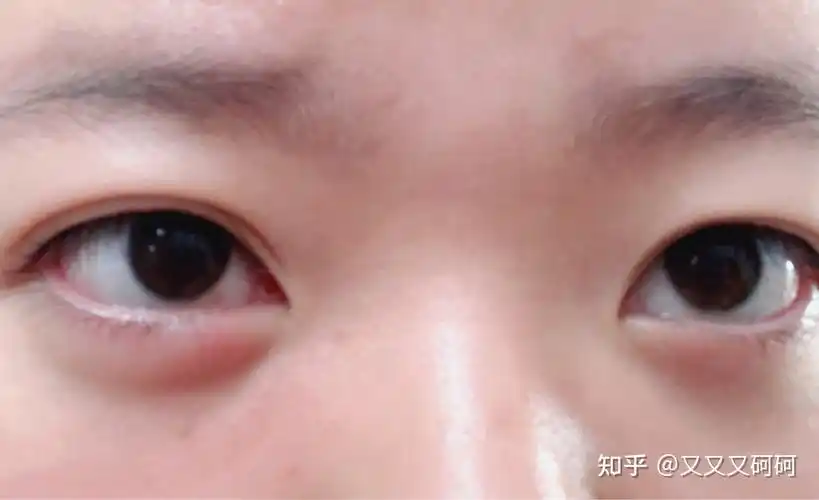 眼睛不知道为什么下眼睑突然肿了? - 知乎