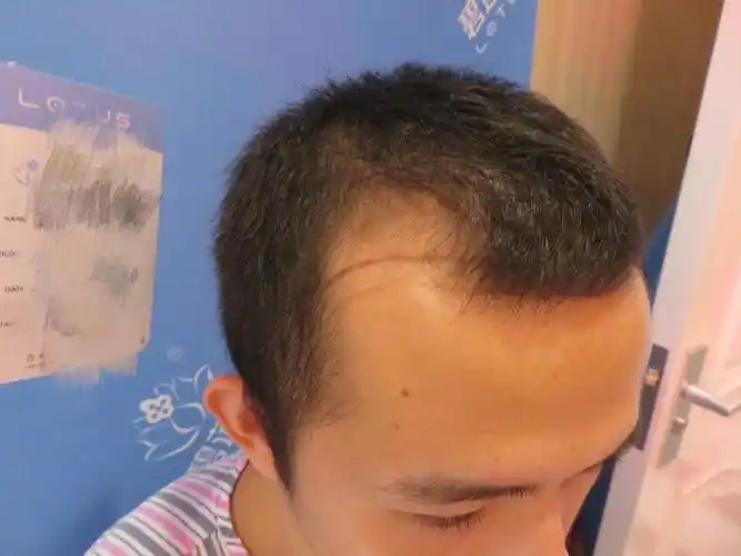 男士发际线