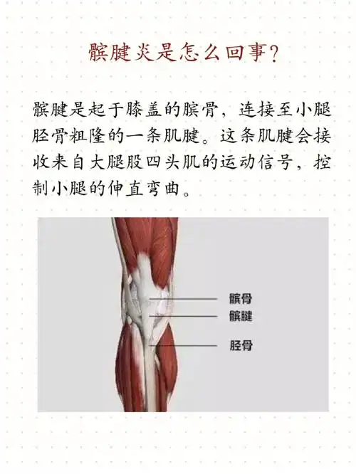 髌腱其实处于膝盖当中,如果我们经常进行膝盖弯曲,那么就会有患髌腱炎