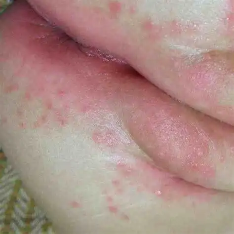 第一毛囊炎引起的皮肤过敏,第二湿疹导致,第三妇科炎症导致外阴皮肤