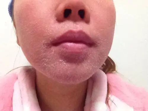 我的脸死皮非常重要,去医院看医生说皮肤受损严重,要