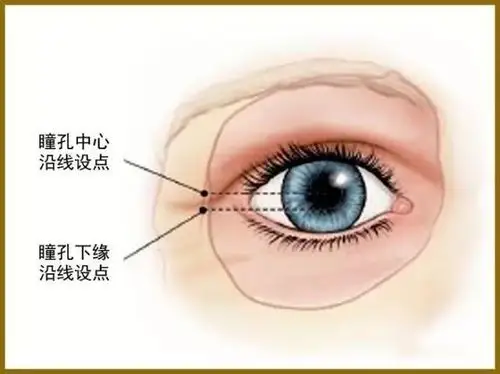 外侧韧带固定有助于调整下睑的位置和矫正眼睑老化(图17-19)