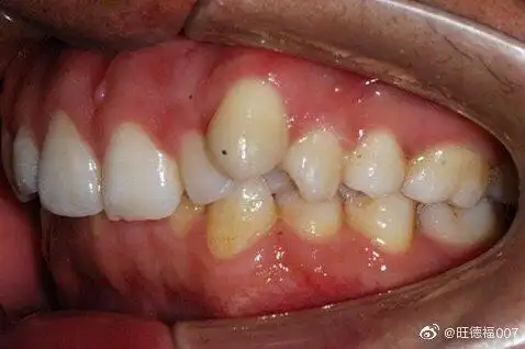 一颗特别突出的尖牙