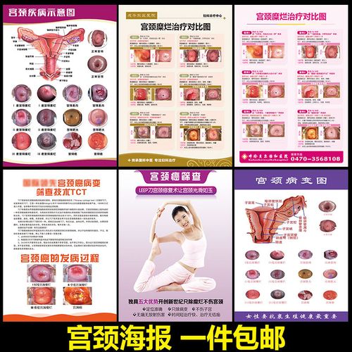 宫颈疾病示意图妇科墙贴病变级别海报女性子宫图片美容院挂图2118