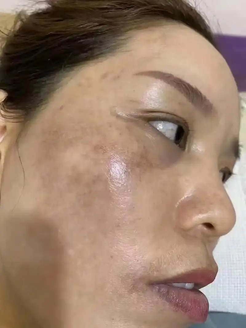 [福][福][福]英姐的皮肤状态很好 黄褐斑 角质层薄  用 - 抖音