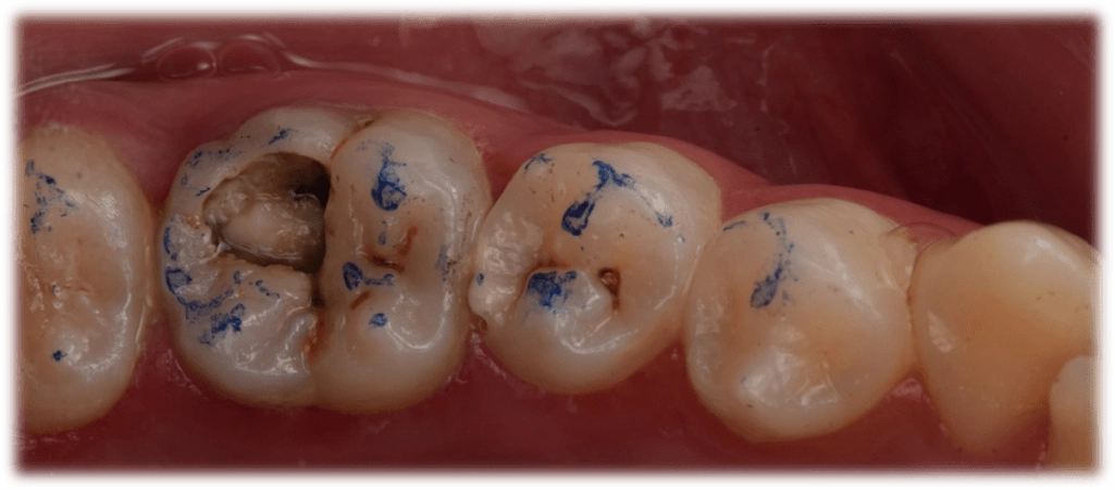 全国决赛12强病例展示 王林强 二类洞直接修复一例:右下五树脂充填