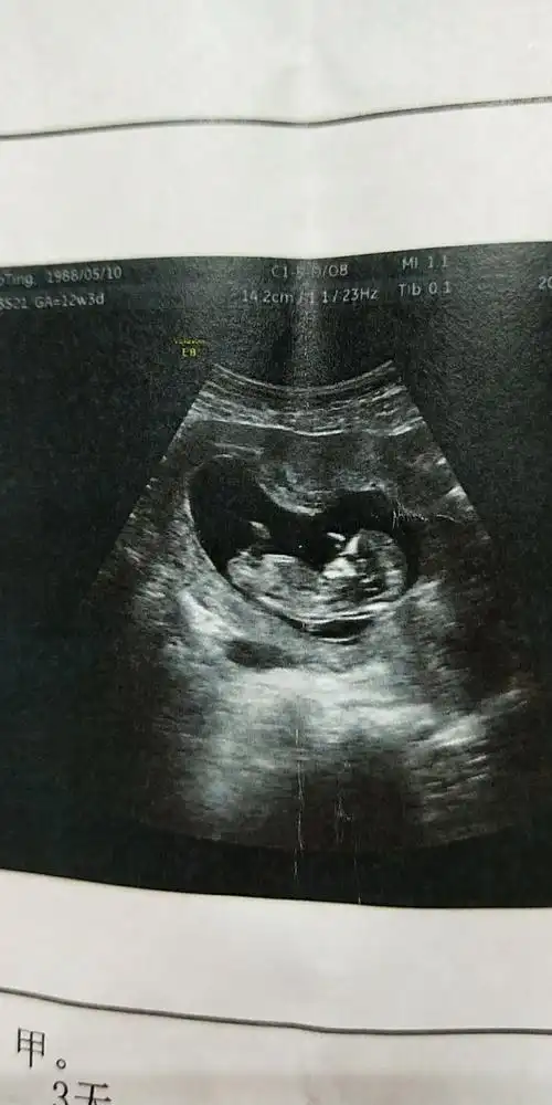 孩子12周的b超图,同事说孕瓤是茄子形状,多是男孩,大伙怎么看?