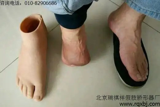 半足假肢多少钱足截肢患者如何装配半足假肢