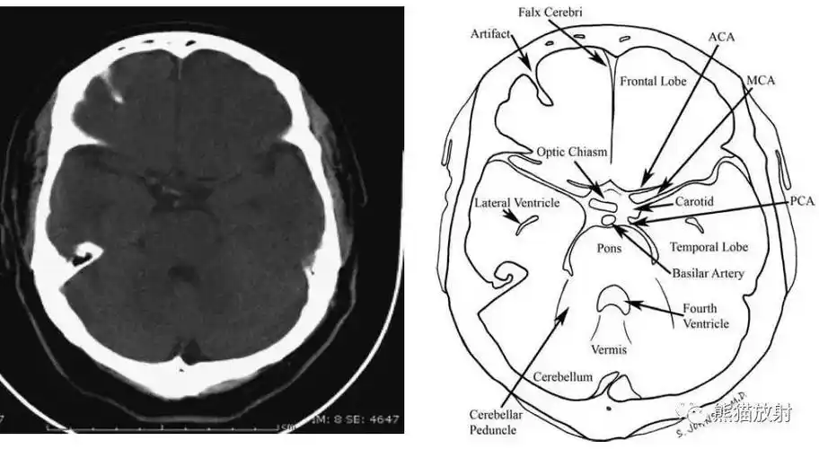 颅脑ct的正常解剖