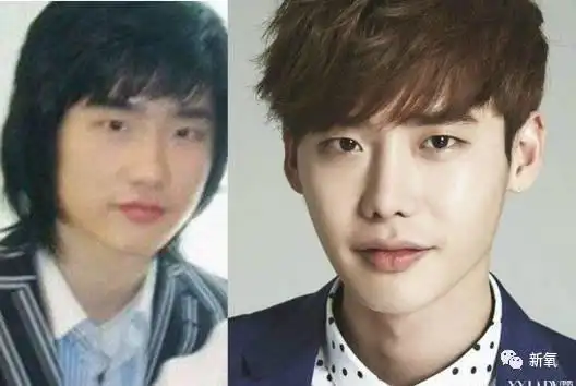 李钟硕整容?鼻子变形坍塌,遭遇沈梦辰同款后遗症?