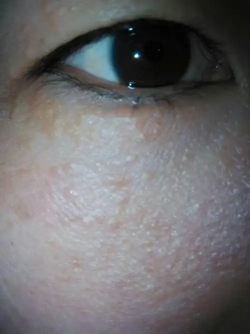 我34女,眼睛周围有很多小疙瘩,是什么,怎么去掉?